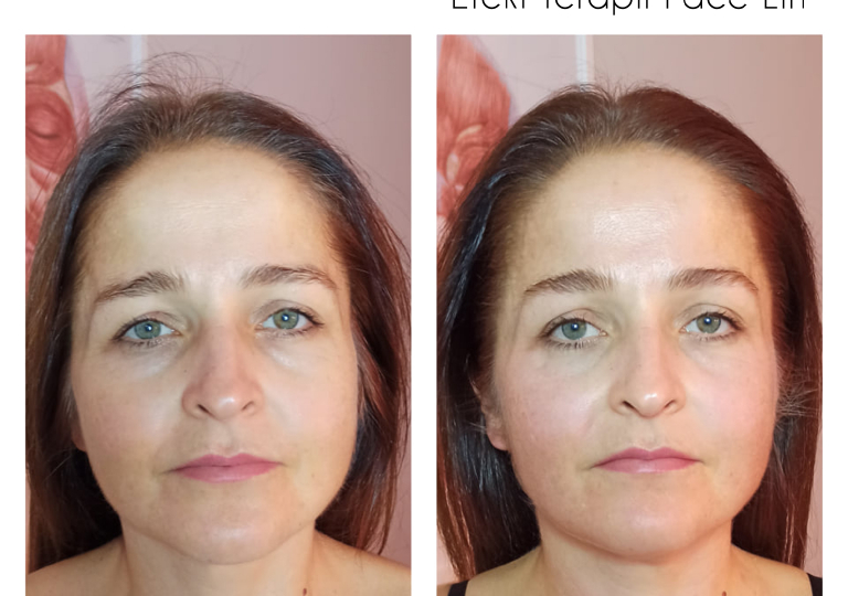 facelift-efekt-2