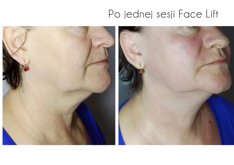 facelift-efekt